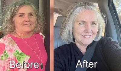 Before and After Photos of Florida's Premier Wellness Medical Group in Tampa, FL